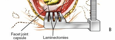 Illustration 17 for Approach to the Lumbar Spine: Mastering Techniques & Anatomy