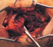 ORIF for Medial Epicondyle Fractures: Restoring Full Range of Motion