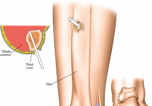 Illustration 39 for Key Approaches for External Fixation: Humerus, Radius, Ulna, Wrist