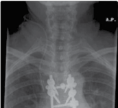 Illustration 10 for Mastering Thoracolumbar Surgery: Full Operative Planning