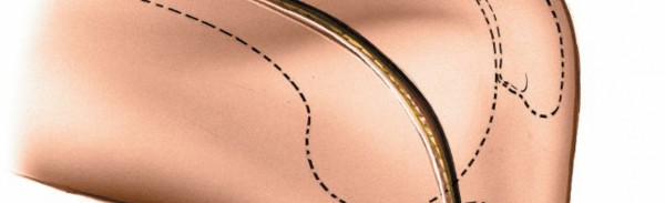 Illustration 142 for Mastering Knee Approaches: Spotlight on Superficial Medial Ligament