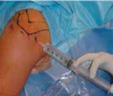 Illustration 13 for Capsular Releases for Loss of Motion: Restore Your Shoulder