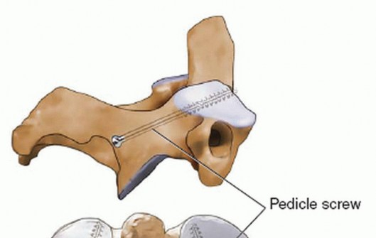 Illustration 19 for Master Techniques for Cervical Fracture Reduction: Type III & More