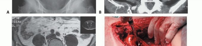 Illustration 39 for Pelvic Metastasis Surgery: A Component of the Utilitarian Approach