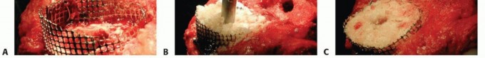 Illustration 8 for Bone Loss Bone Grafting for Challenging Tibial Defects