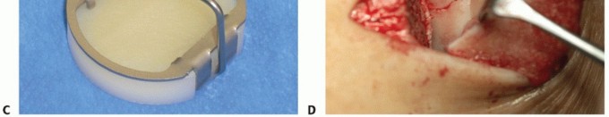 Illustration 11 for Restore Damaged Cartilage with Autologous Chondrocyte Transplantation