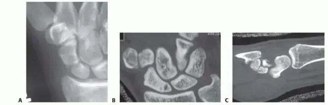 كسر عظم الزورق في الرسغ: دليلك الشامل للتشخيص، العلاج، والتعافي مع الأستاذ الدكتور محمد هطيف