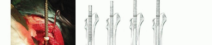 Illustration 17 for Exeter Hip Unit: Mastering Impaction Allografting for Femoral Bone Loss