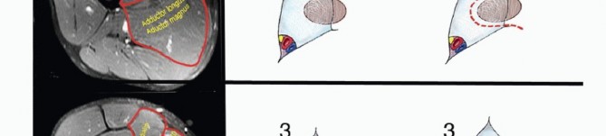 Illustration 5 for Optimizing Resection: An Overview of Surgical Approaches for Space Sarcomas