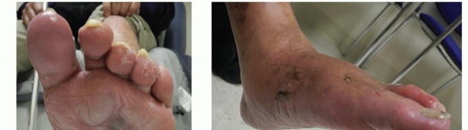 Illustration 28 for Regain Mobility: Surgical Solutions for Charcot Foot Arthropathy