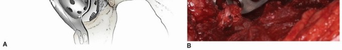 Illustration 15 for Uncemented Acetabular Component: Augments & Cup-Cages for Bone Loss