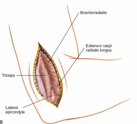 Illustration 77 for Mastering the Approach to the Distal Humerus: Safety & Skills