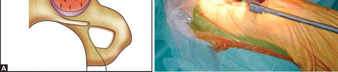 Illustration 5 for Optimizing Acetabular Component Cementation for Superior Outcomes