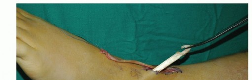 Illustration 50 for Restore Movement: Tendon Transfer for Common Peroneal Nerve Foot Drop