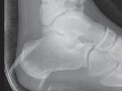 Illustration 17 for Optimizing ORIF for Tibial Plafond Fractures: A Modern Approach