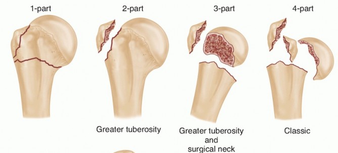 Illustration of fixation of proximal - Dr. Mohammed Hutaif