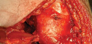 Illustration 74 for Unlock the Figure Posterior Approach to the Hip