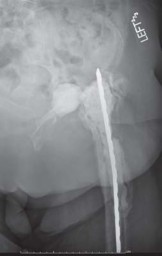 Illustration 34 for THA for patients with proximal femoral deformity: Practical solutions