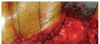 Illustration 16 for Revision THA: Why Extensively Porouscoated Cylindrical Stems Excel