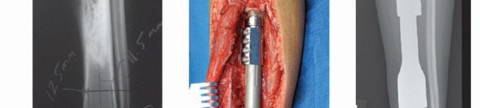 Illustration 27 for Distal Femoral Replacement: Key to Modern Limb Salvage