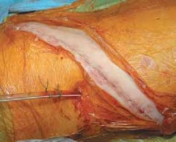 Illustration 53 for Mastering Anterior Interbody Arthrodesis with Instrumentation for Scoliosis