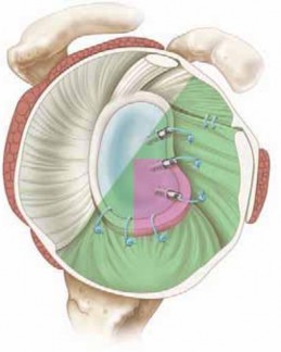 Illustration 6 for Regain Stability: Anterior Shoulder Instability Arthroscopic Fix
