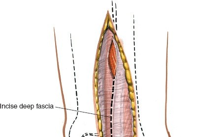Illustration 68 for Optimized Approaches to the Dorsum of the Foot & Ankle