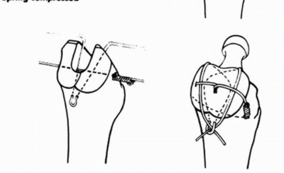 Illustration 29 for Sliding Trochanteric Osteotomy: Modern Role & Refined Techniques