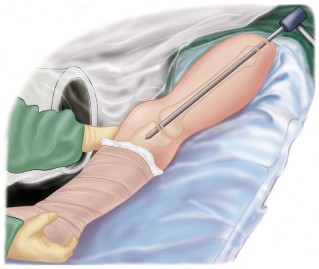 Illustration 18 for Arthrodesis with an Intramedullary Nail: Fixing Failed TKAs