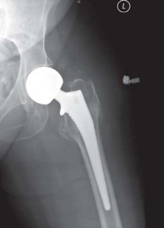 Illustration 18 for Mastering Fractures After Total Hip Arthroplasty
