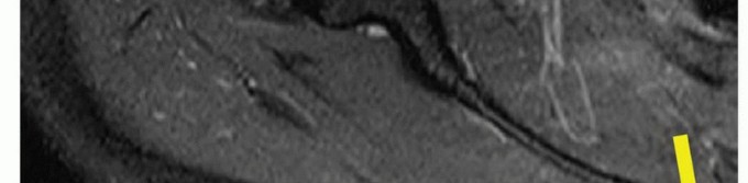 Illustration 10 for Is Your Dorsal Scapular Nerve Causing Snapping Scapula Pain?