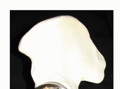 Illustration 5 for Pelvic Discontinuity: Understanding Superior and Inferior Separation