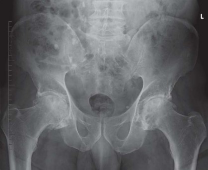 Illustration 62 for Kinectiv® Stem: Modular Necks for Primary THA Success