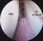 Illustration 21 for Capsular Releases for Loss of Motion: Restore Your Shoulder