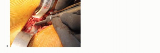 Illustration 30 for Anterior FAI Relief: Mini-Open Anterior Approach Explained