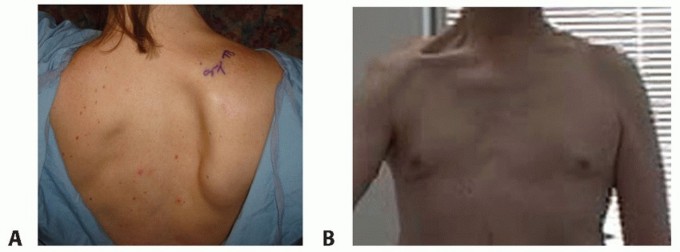 Illustration 6 for End CN XI Palsy Pain: The Eden-Lange Procedure Solution