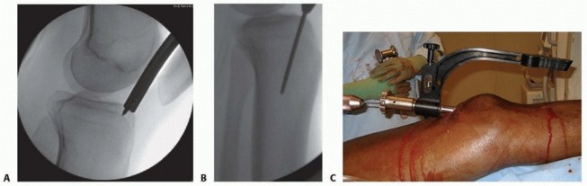 Illustration 41 for Optimizing Intramedullary Nailing for Tibial Shaft Fractures