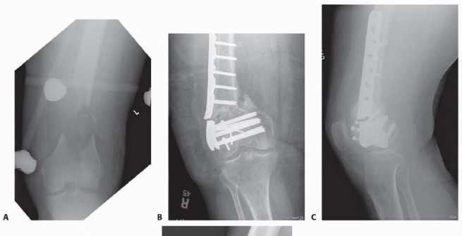 Illustration 74 for Repairing Distal Femur Fractures: Open Reduction & Internal Fixation