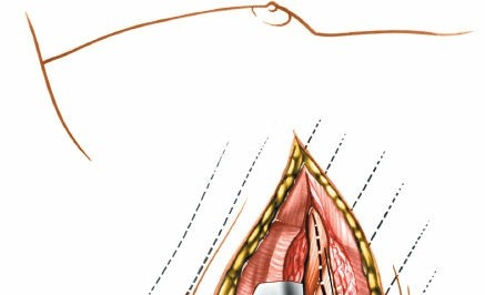 Illustration 312 for Approach to the Lumbar Spine: Mastering Techniques & Anatomy