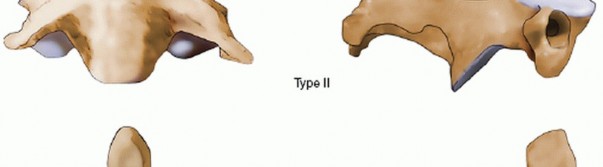 Illustration 8 for Master Techniques for Cervical Fracture Reduction: Type III & More