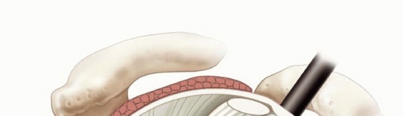 Illustration 20 for Regain Stability: Arthroscopy for Anterior Instability & the Inferior Glenohumeral Ligament