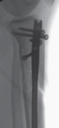 Illustration 56 for Optimal Nailing of the Tibia: Techniques for Challenging Fractures
