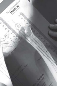 Illustration 19 for Successful Total Hip Replacement in Developmental Dysplasia