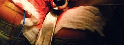 Illustration 70 for Metal on Metal Resurfacing: Enhanced Posterior Soft Tissue Repair