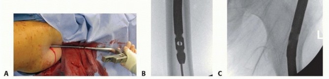 Illustration 22 for Pediatric Femoral Nailing: Targeting the Right aspect of the greater Trochanter