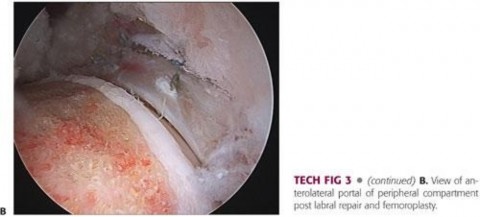 Illustration 108 for Precision Hip Arthroscopy: Unlock Access to the Peripheral Compartment
