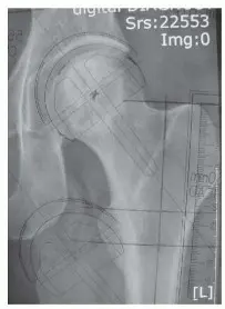 ترميم مفصل الورك: الحل الأمثل للحفاظ على عظم رأس الفخذ في صنعاء مع الدكتور محمد هطيف