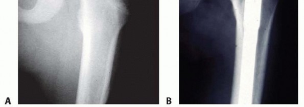 Illustration 6 for Pediatric Femoral Nailing: Targeting the Right aspect of the greater Trochanter
