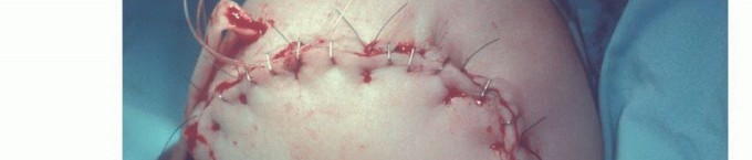 Illustration 27 for Above-Elbow & Below-Elbow Amputations: When & Why They're Needed