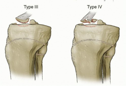 Illustration 3 for Treating Tibial Spine Fractures: Arthroscopy or Open Reduction?